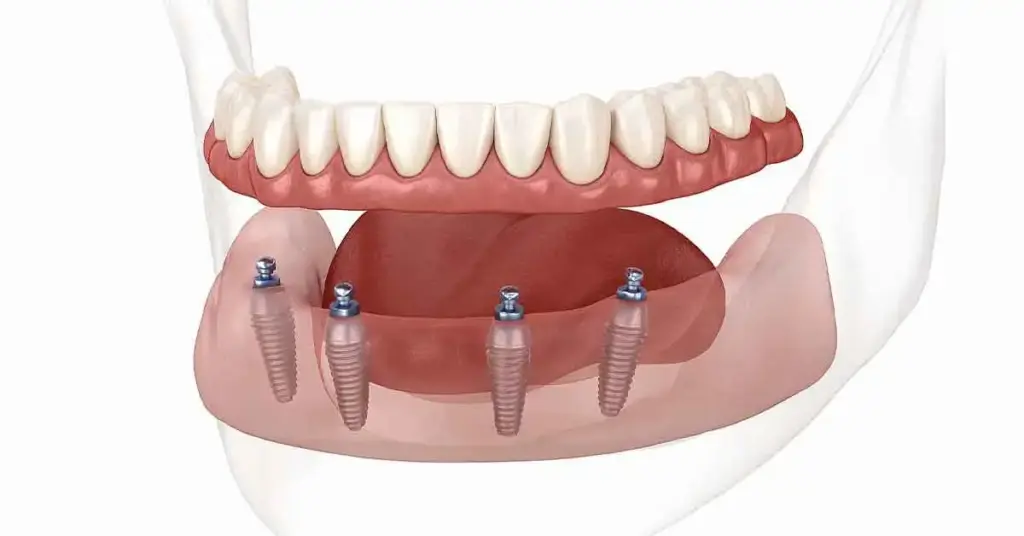 All on Four Implant Treatments