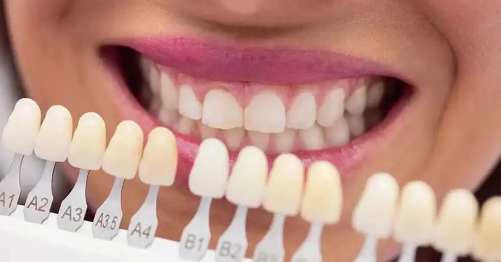 dental veneer colors