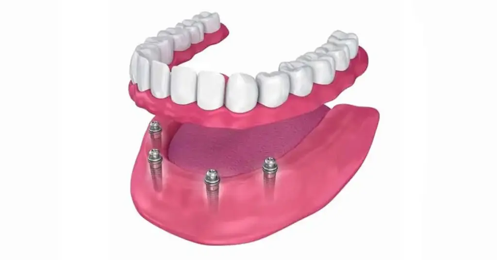 all on four implants