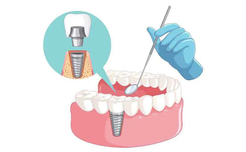 How is a dental implant performed