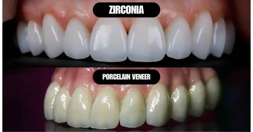 zirconium veneer and porcelain veneer