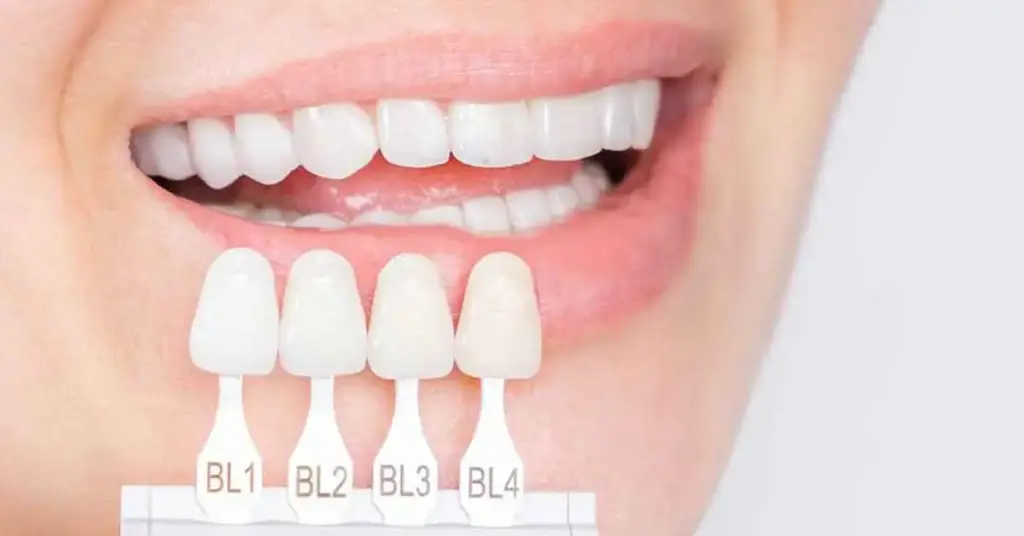 dental veneer colors