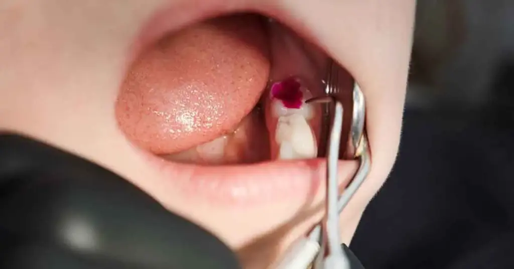 Care After Root Canal Treatment​