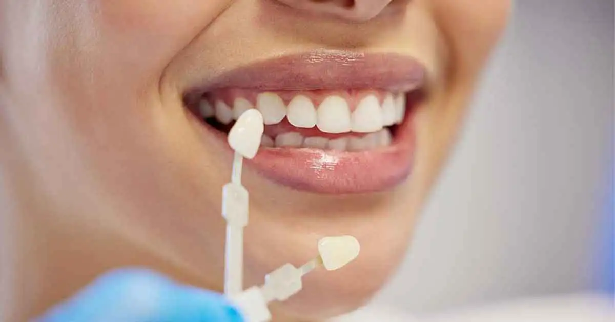 Dental treaments veneers