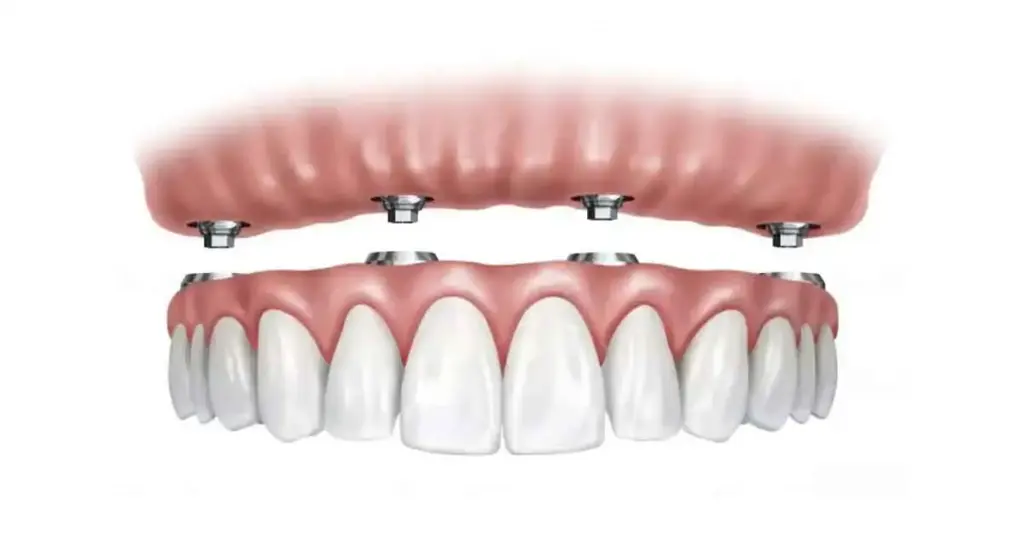 all on four dental implants