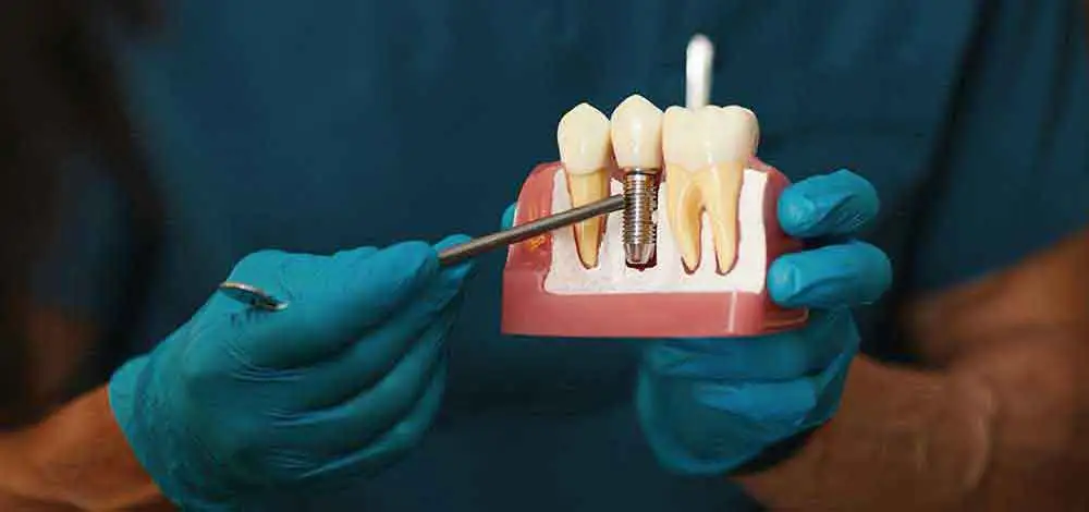 Dental İmplants