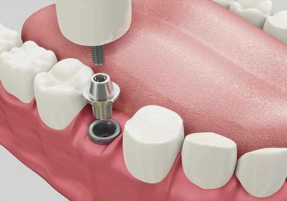 Dental implants treaments