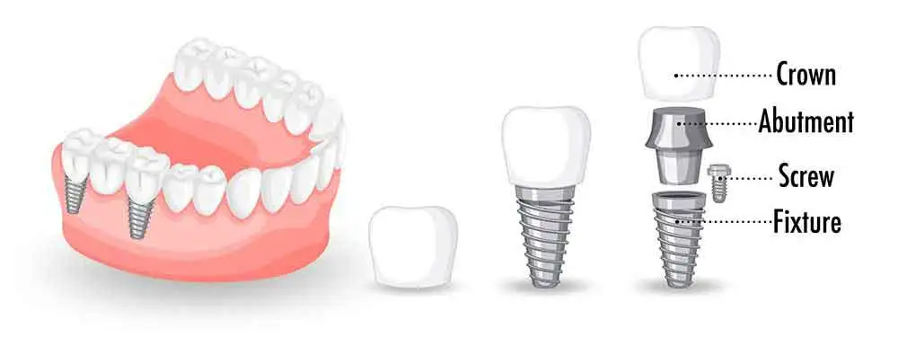 dental implant stages