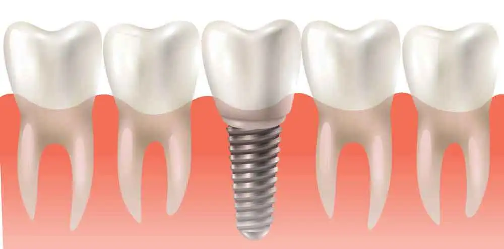 Dental implants