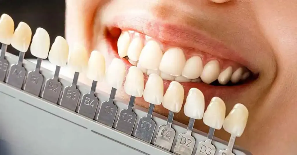 Emax Veneer treaments