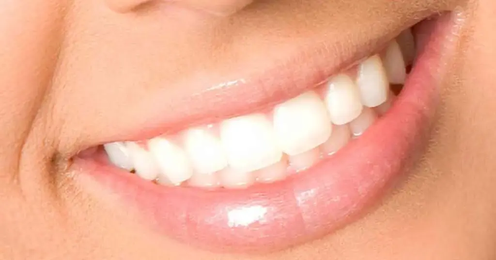 Hollywood Smile Treaments