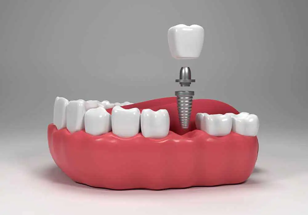 Dental implants treaments