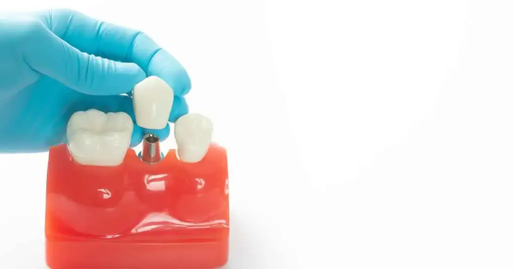 Dental implants care