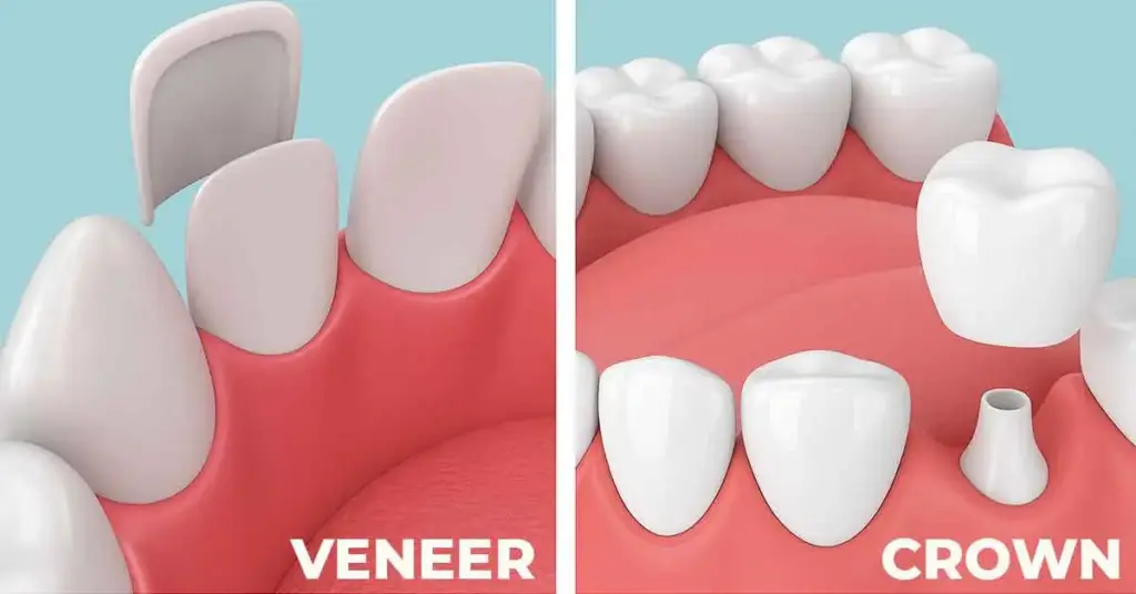 Veneer and Crown Treaments