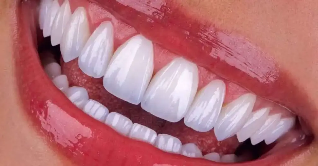 Emax Veneers