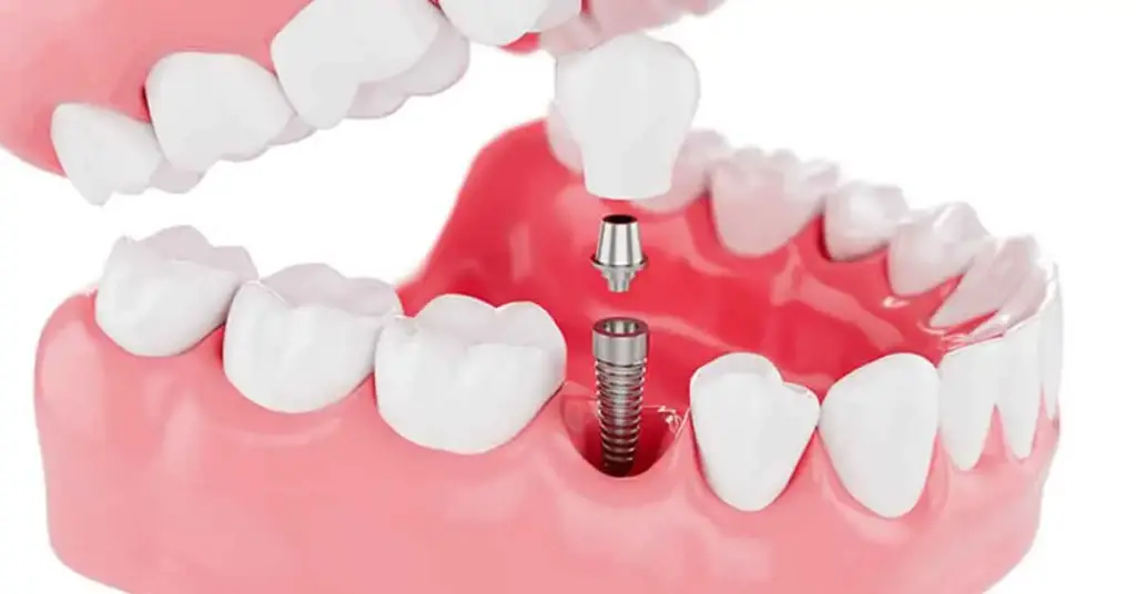 BEGO Implants