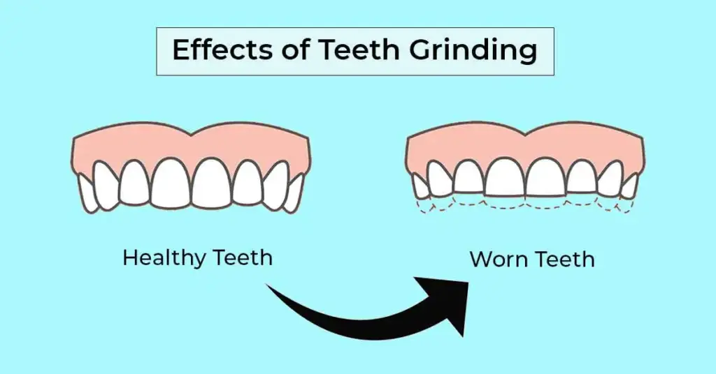 Teeth Grinding