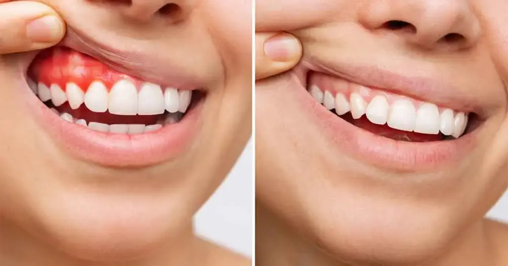 Gum Recession care