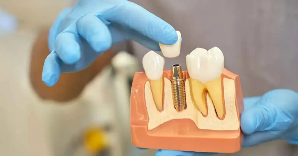implant treatment
