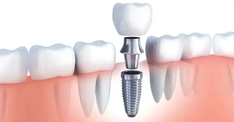BioHorizons Implants