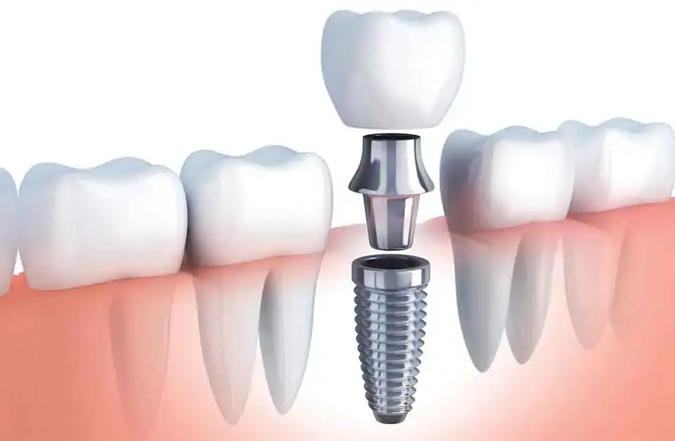 BioHorizons Implants