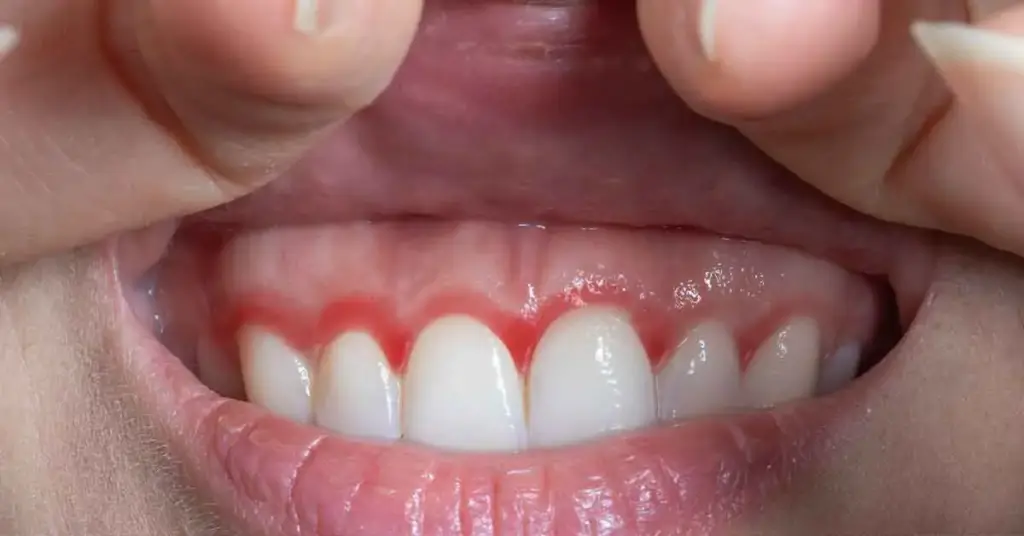 Gum Recession Treatment
