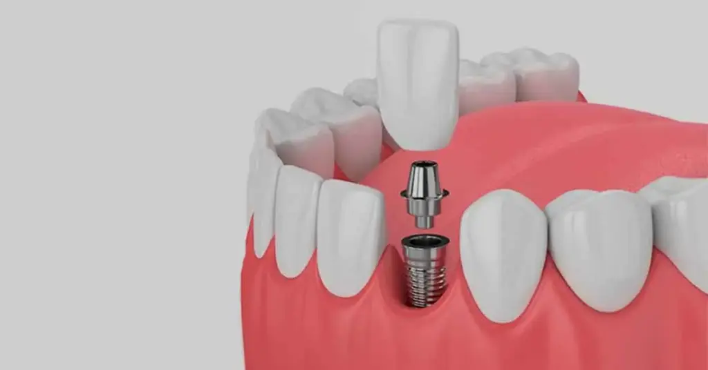 Hiossen Implant