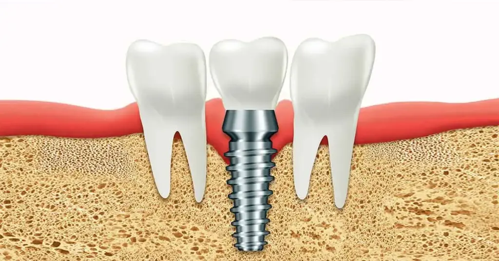 implant lifespan
