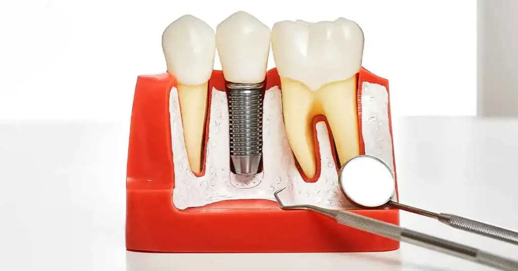 dental implant prices