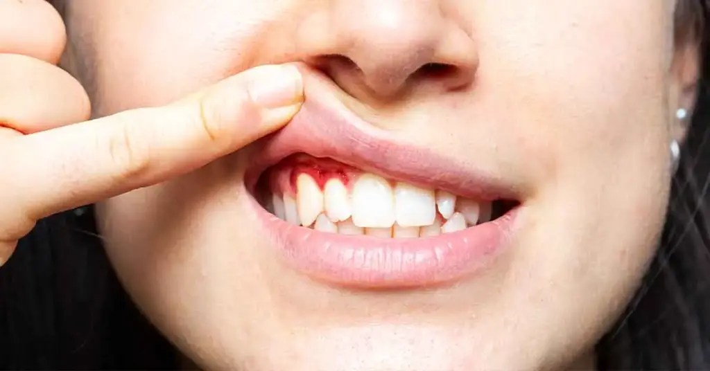 Symptoms of Gum Recession