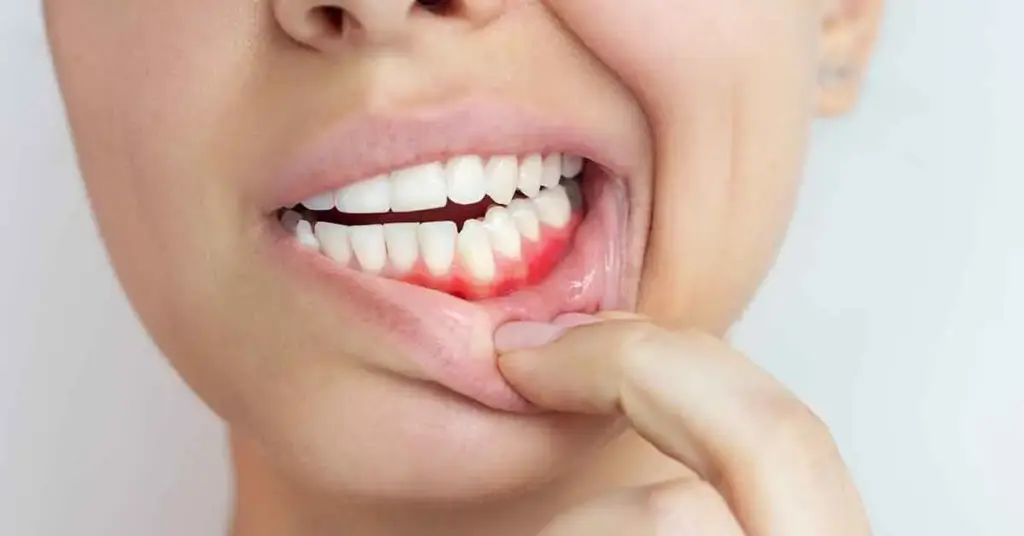 Gum Recession