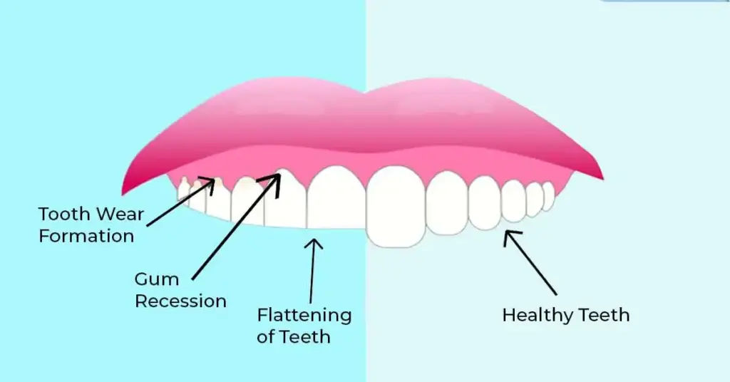 Bruxism