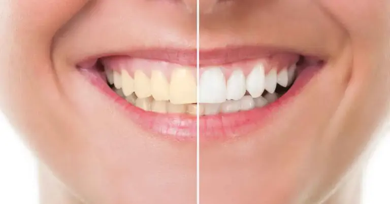 teeth whitening