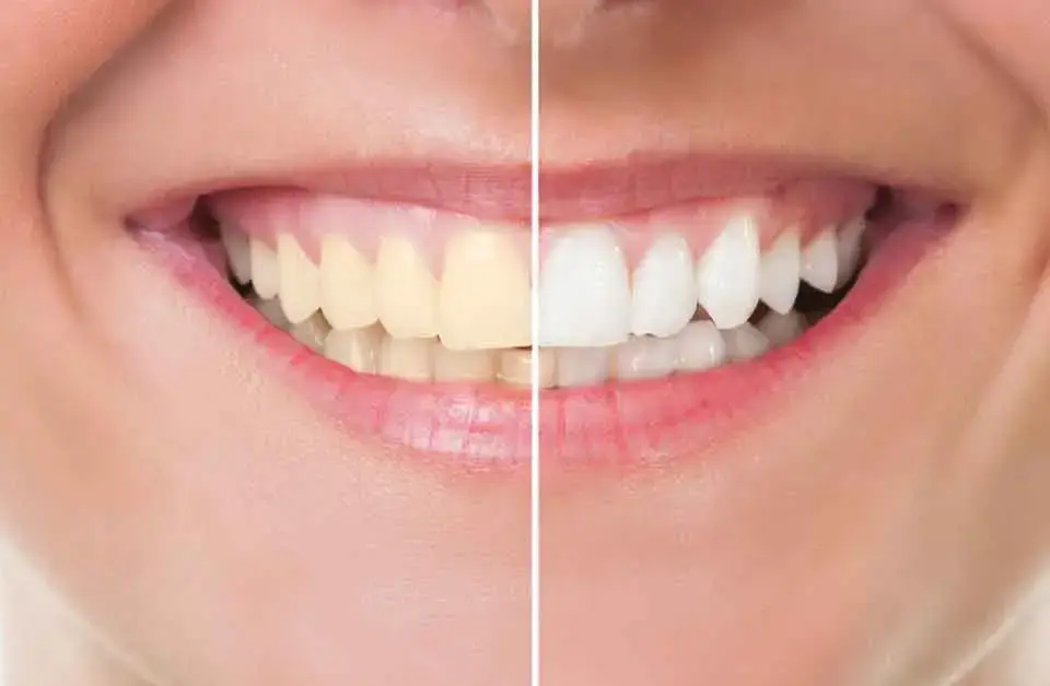 teeth whitening