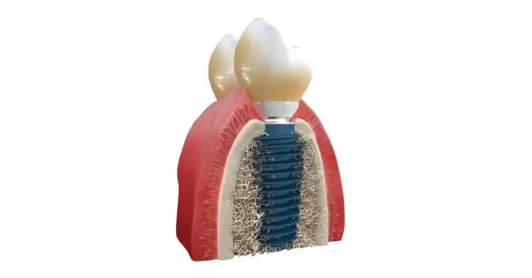 Megagen Dental Implants