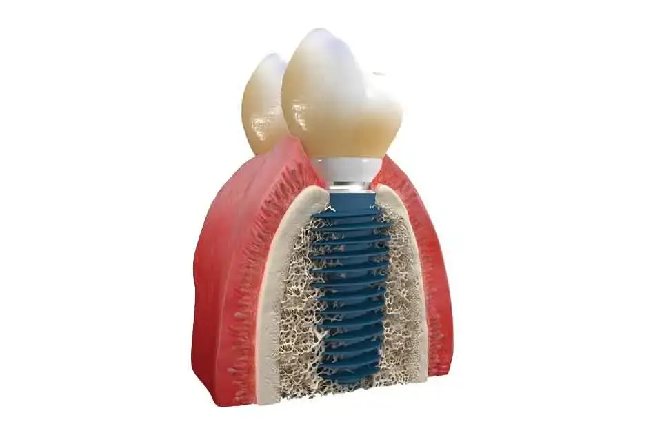 Megagen Dental Implants