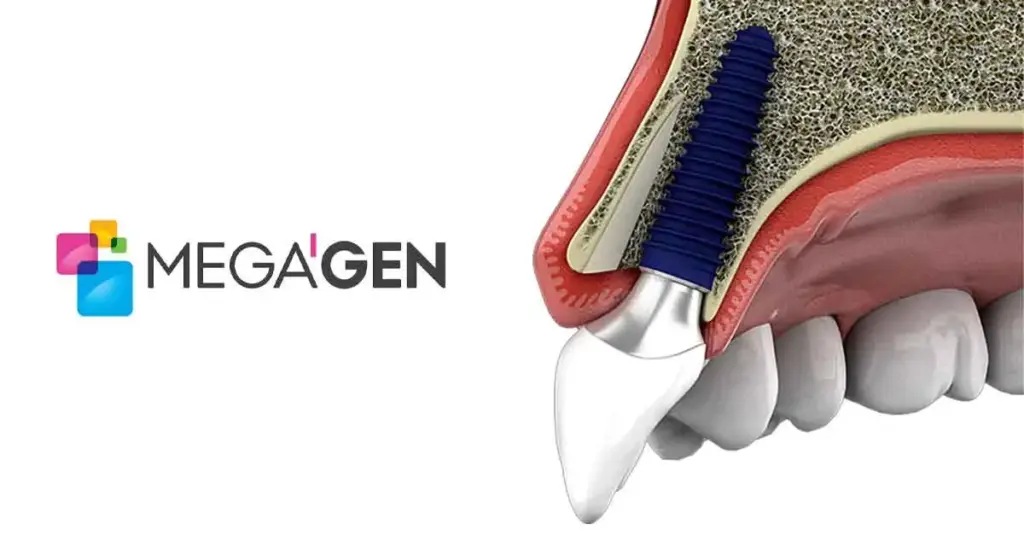 Megagen Implants