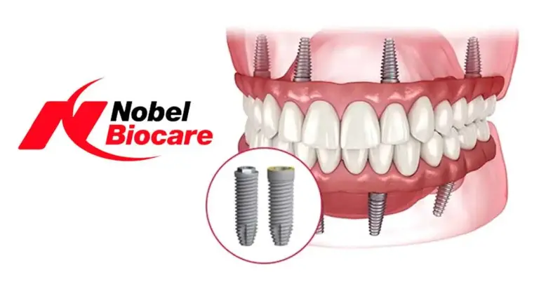 Nobel Biocare Implants