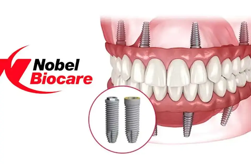 Nobel Biocare Implants
