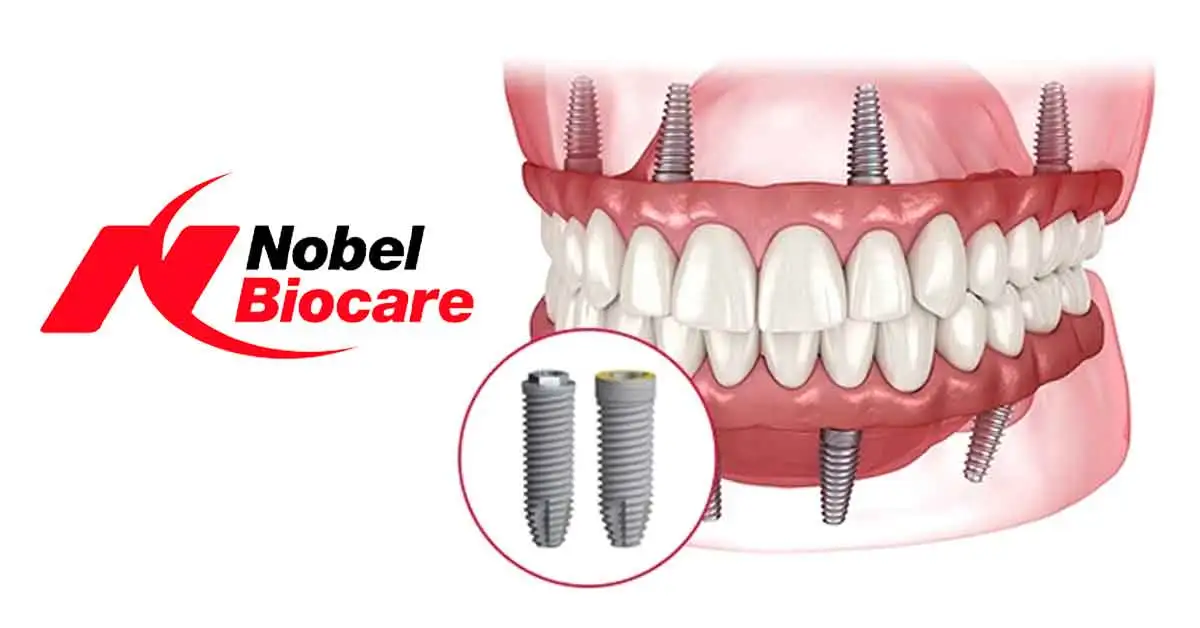 Nobel Biocare Implants
