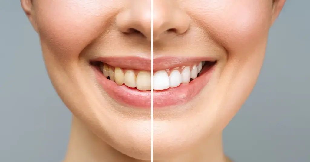 Teeth Whitening Care