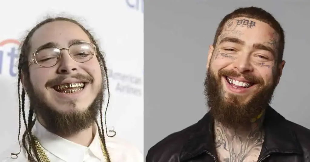 Зубы Поста Мэлоуна до и после