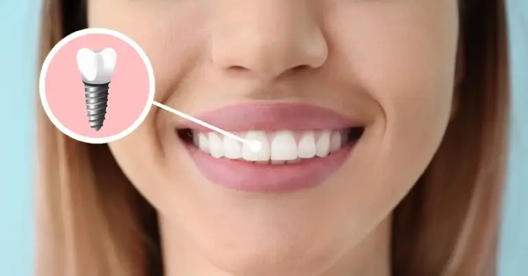 Single tooth aesthetics