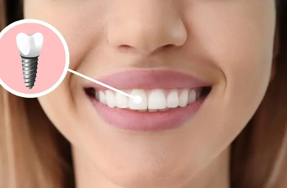 Single tooth aesthetics