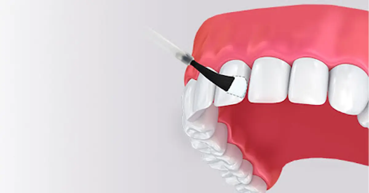 Utilisation du fluorure
