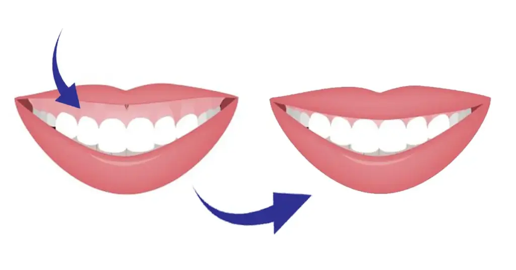 Who performs gummy smile treatment