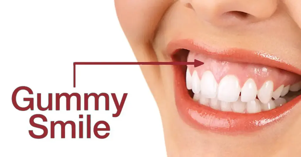 gummy smile