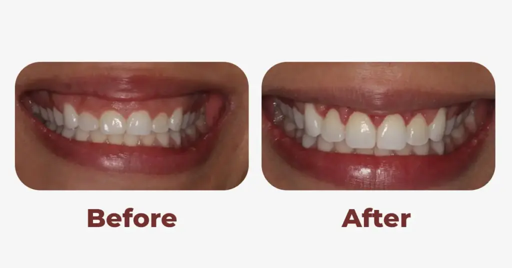 gummy smile before and after
