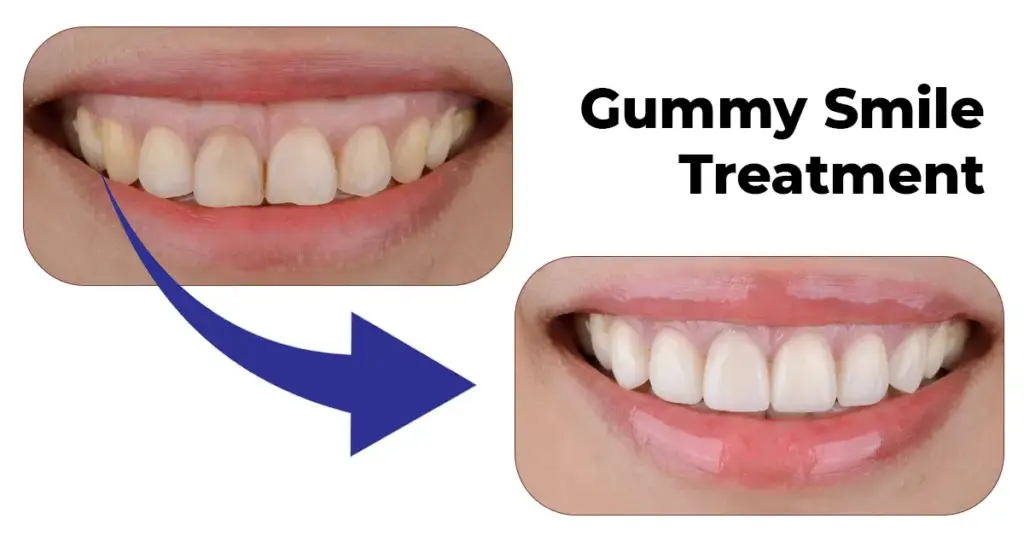 gummy smile treatment