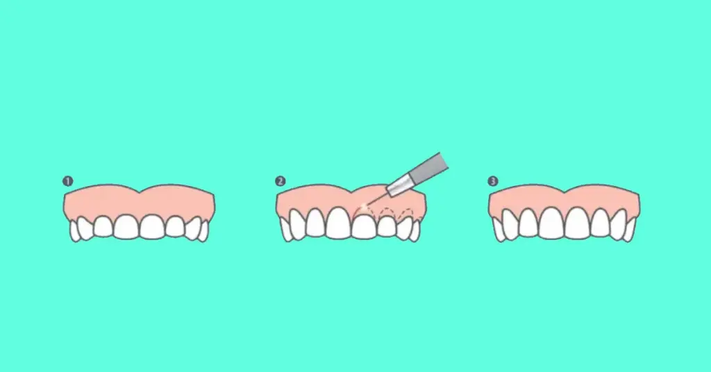 gummy smile treatment